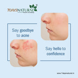 7Days Natural Acne Control Face Scrub for All Skin Type- 100 ml