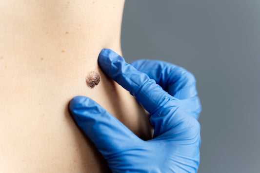 What are warts? How to Remove Warts Naturally with 7DaysNatural Wart Removal Cream