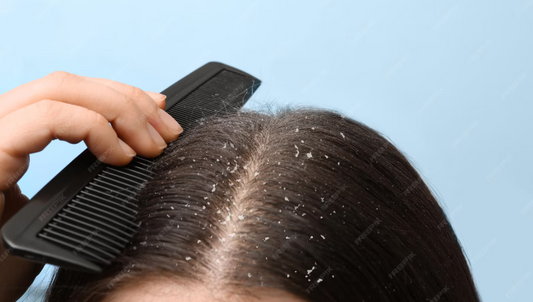 What Causes Dandruff? Best Anti-Dandruff Shampoo with Natural Ingredients