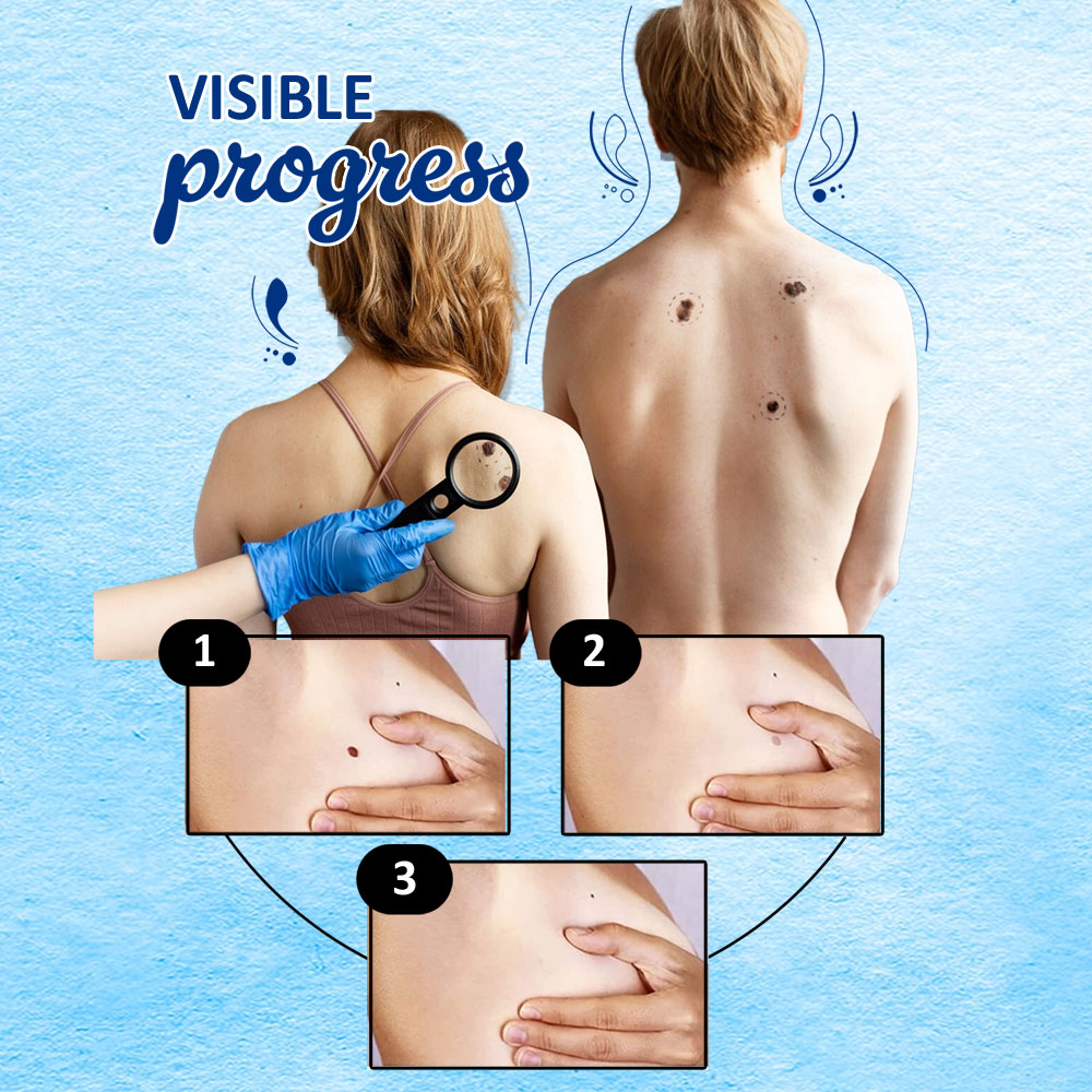 7DAYSNATURAL Wart Removal Cream For Face Wart Removar (50g)