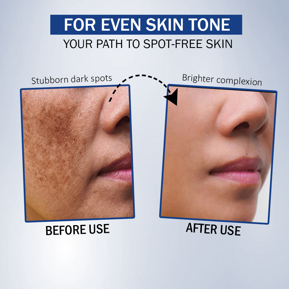 7DAYSNATURAL 2% Kojic Acid Face Serum – Reduces Hyperpigmentation, Acne Marks & Uneven Tone – All Skin Types-30 ML